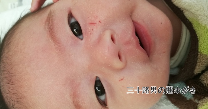 ひっかき傷で血だらけの赤ちゃんの顔を２週間で綺麗にした方法